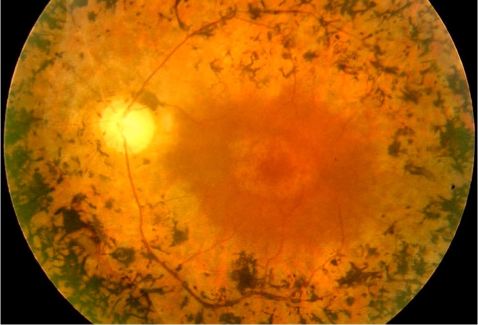 Classic retinitis pigmentosa showing bone spicule pigmentation and attenuated vessels on fundus examination