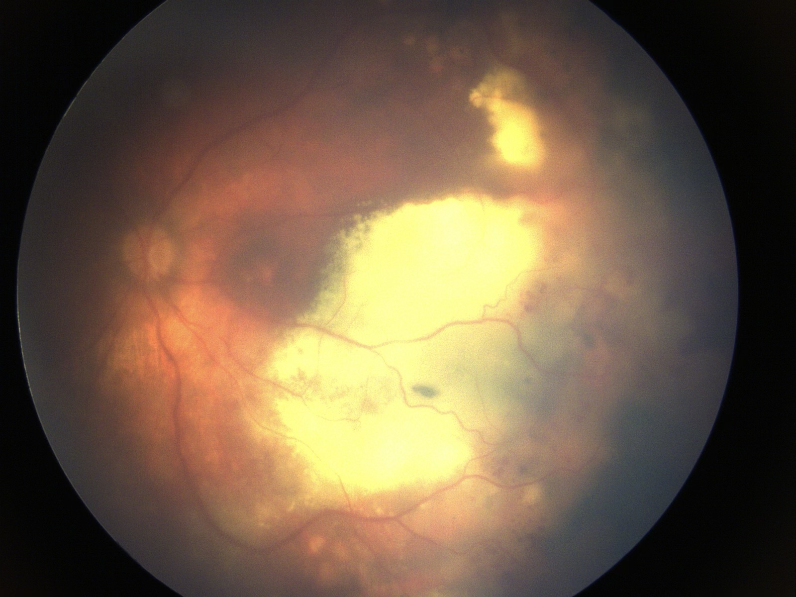 Coats disease showing exudative retinal detachment in a child on fundus examination