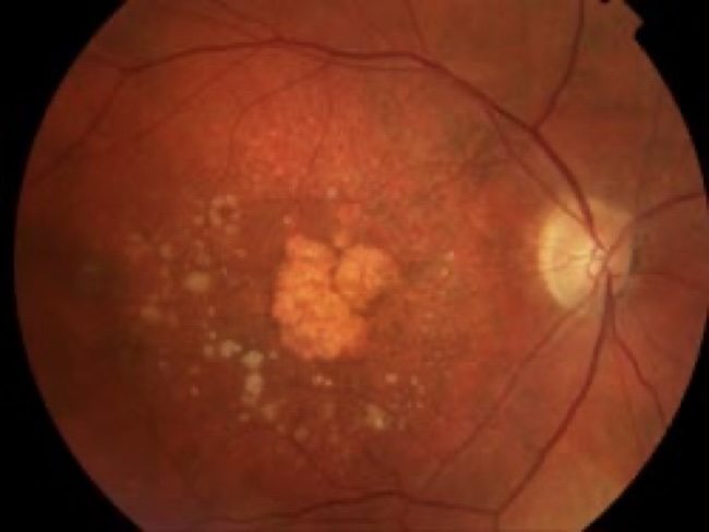 Dry AMD showing drusen deposits and early geographic atrophy at the macula