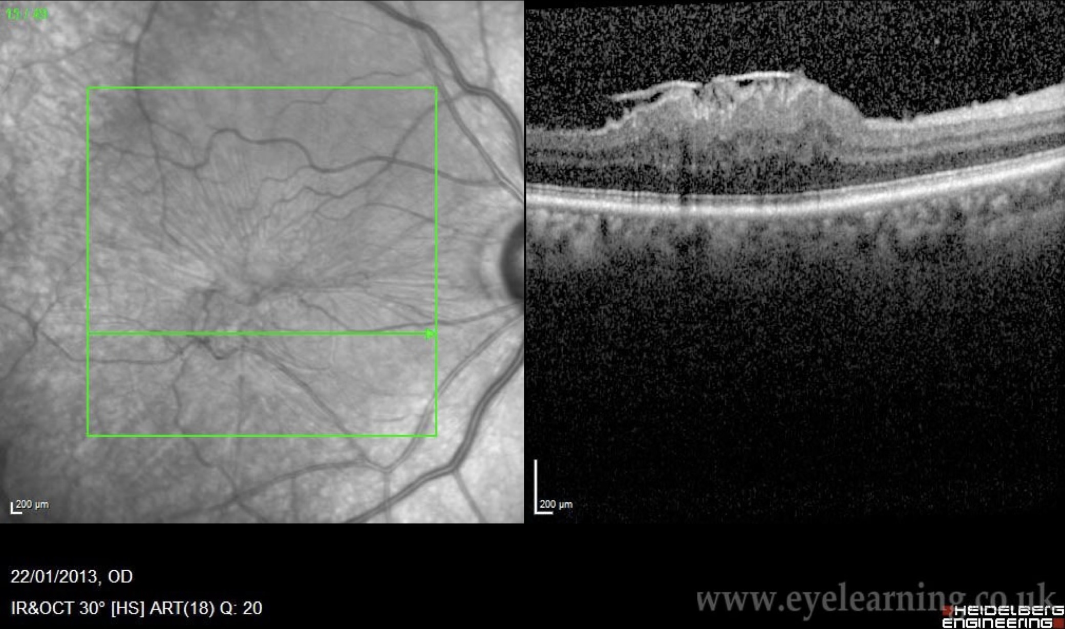 Infrared reflectance and OCT showing epiretinal membrane with macular wrinkling and distortion