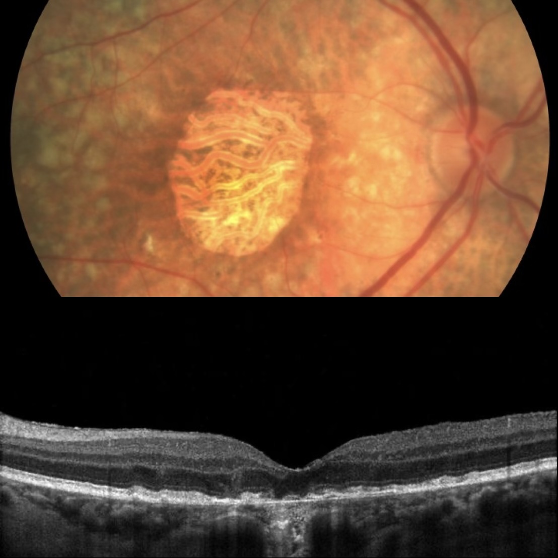 Geographic atrophy in late dry AMD shown on colour fundus and OCT imaging