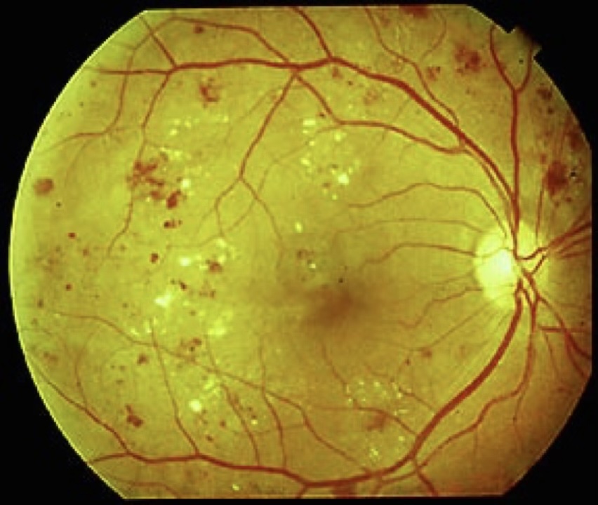 Proliferative diabetic retinopathy showing new vessel formation at the disc