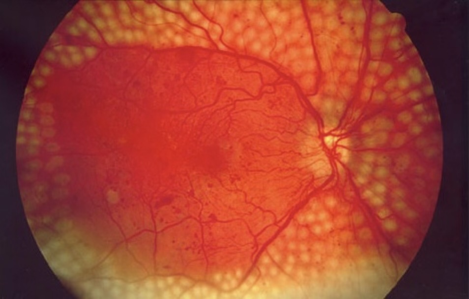 Pan-retinal photocoagulation laser marks visible on fundus examination