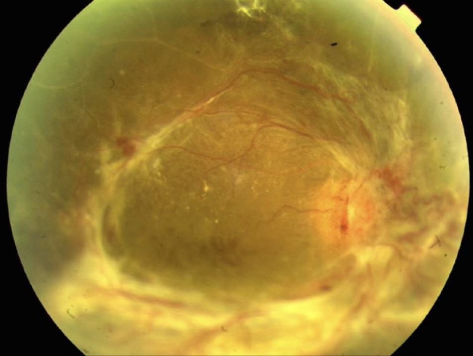 Tractional retinal detachment complicating proliferative diabetic retinopathy
