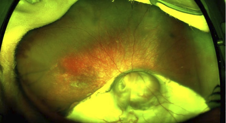 Fundal coloboma in a child as seen on RetCam wide-field retinal imaging at GOSH