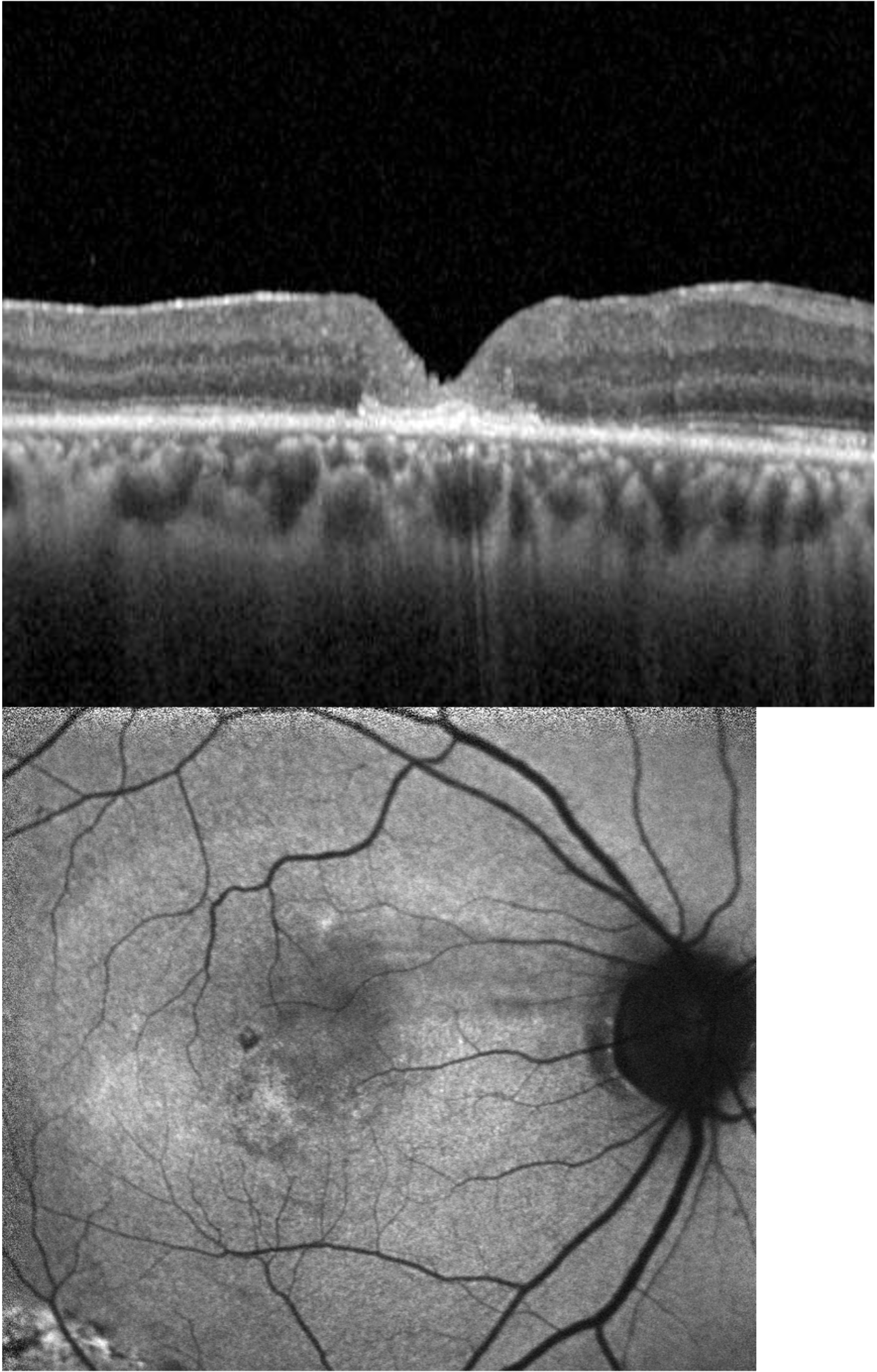 Before and after OCT showing macular hole closure using subretinal amniotic membrane transplantation