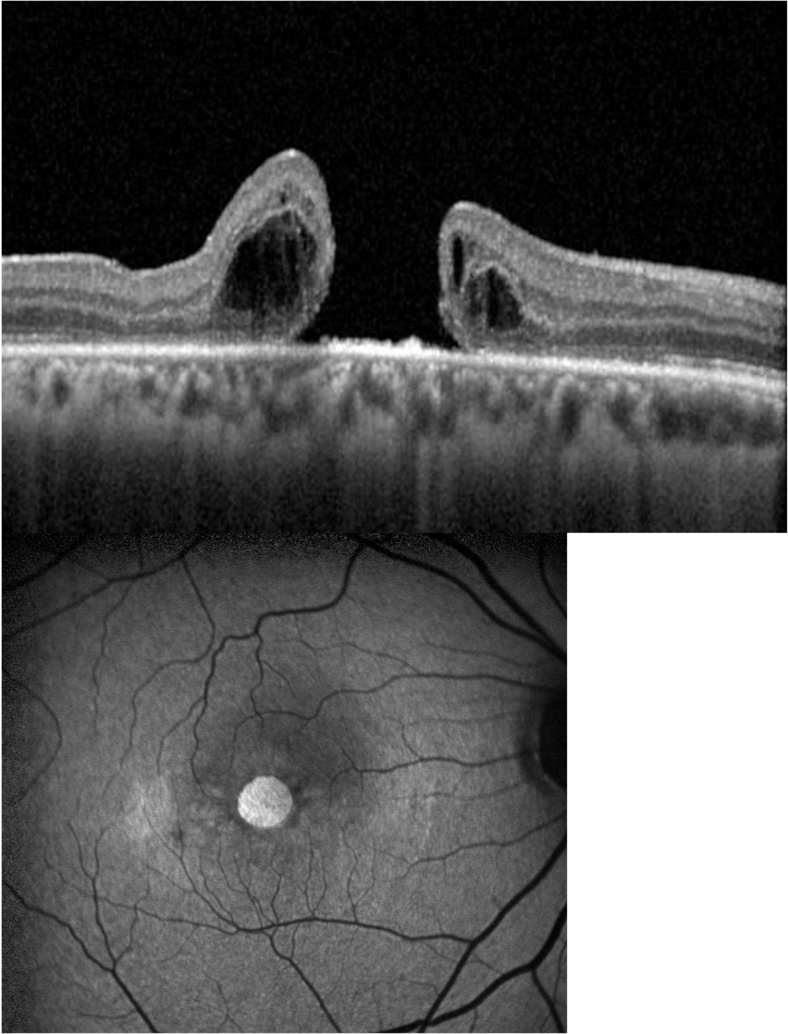 Large full-thickness macular hole on OCT scan greater than 600 microns