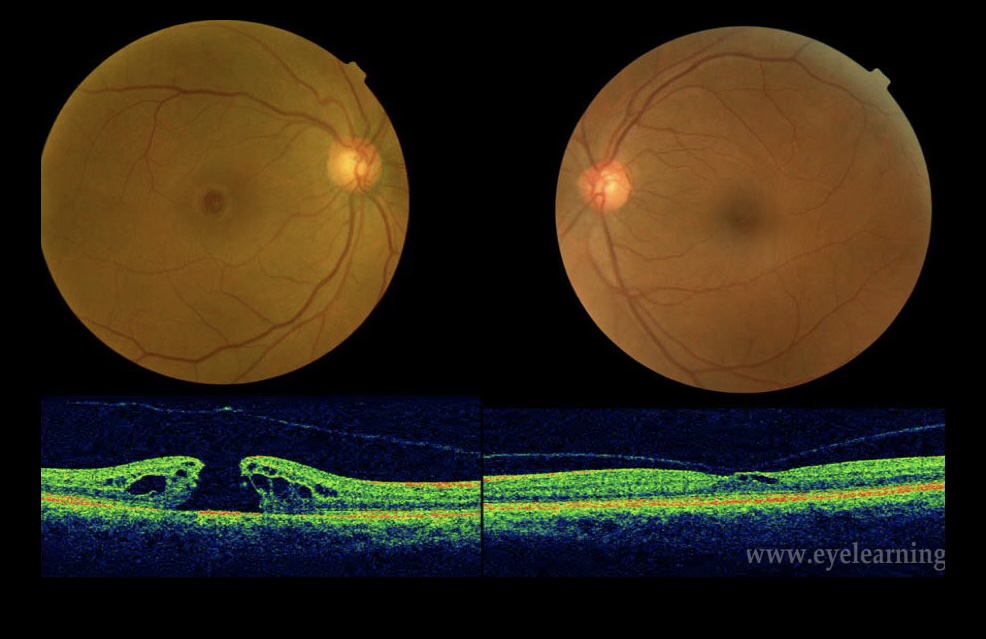 OCT scan showing macular hole alongside vitreomacular traction for comparison