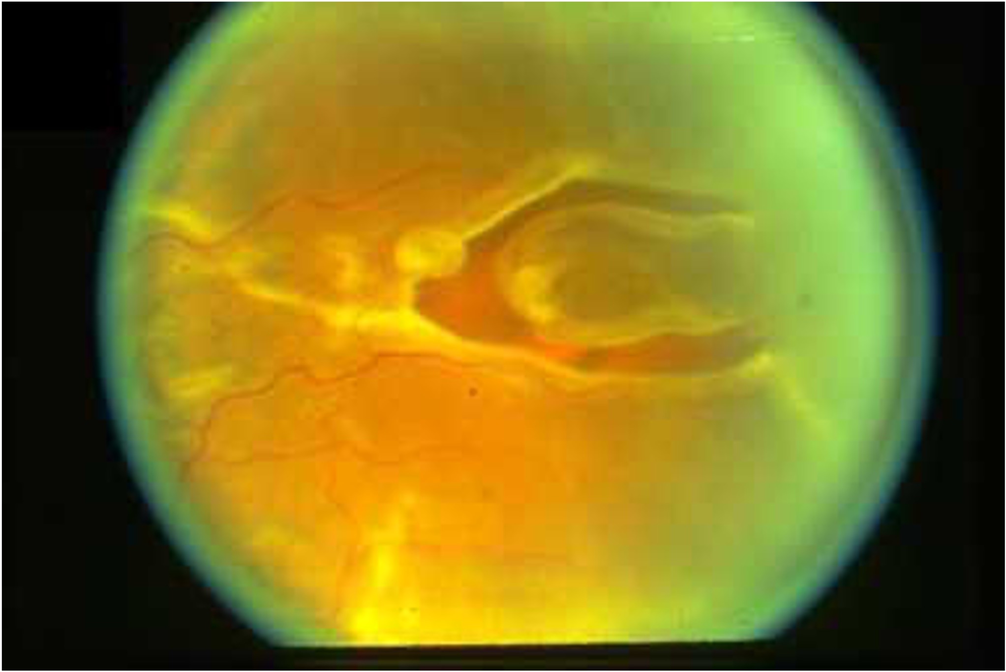 Retinal tear visible on fundus examination before laser treatment