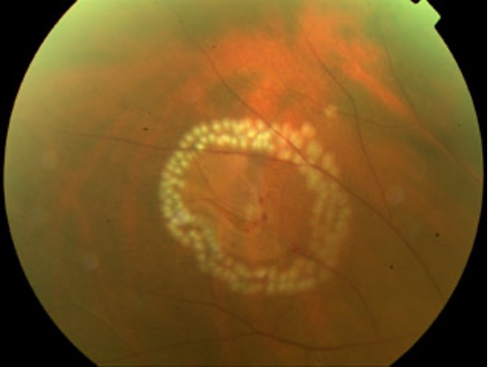 Laser retinopexy applied around a retinal tear to prevent detachment