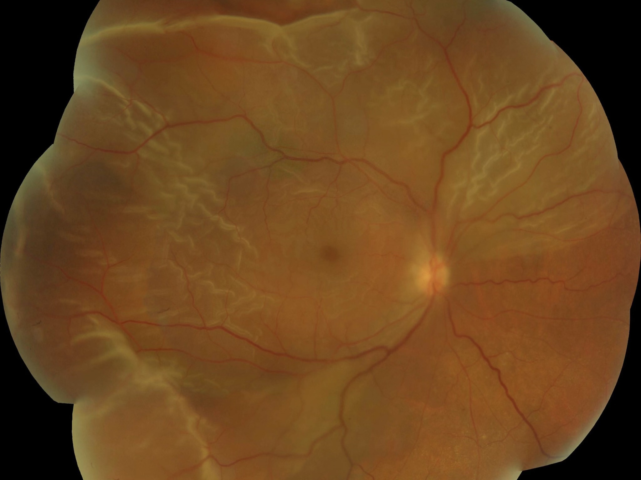 Total rhegmatogenous retinal detachment as seen on fundus examination