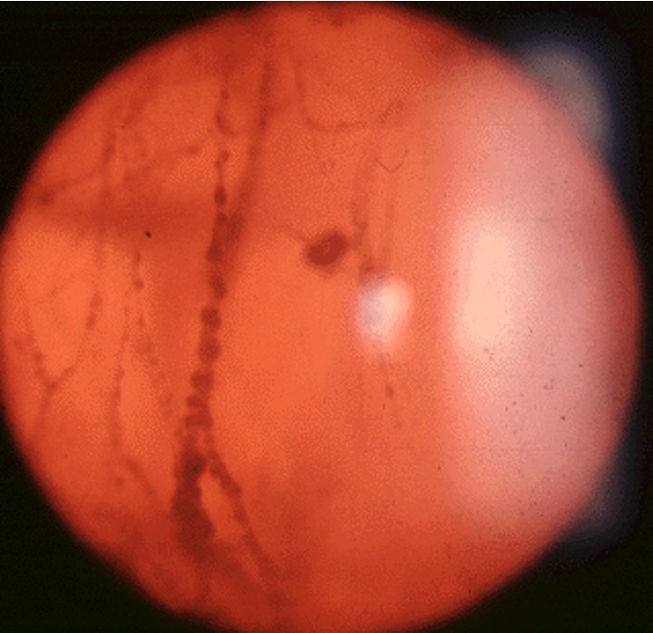 Vitreous opacity and vitritis on fundus examination