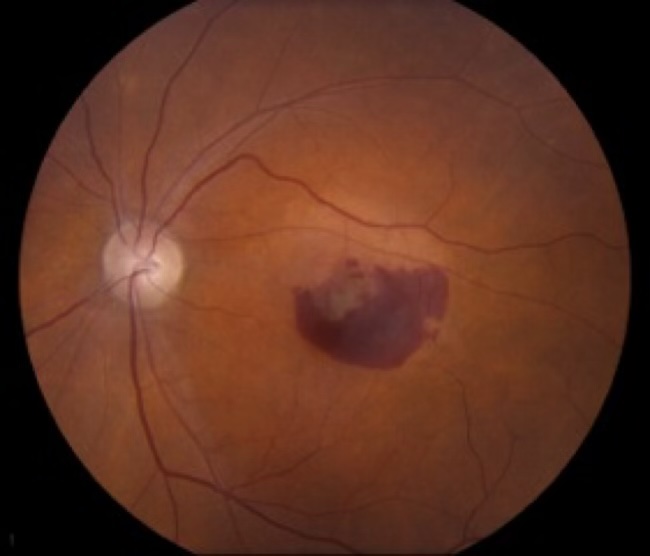 Wet AMD showing subretinal haemorrhage and fluid on fundus examination